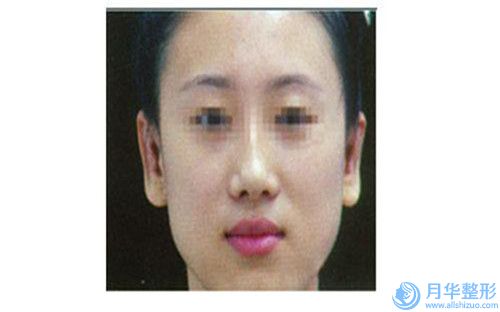 資陽市重度乳房下垂矯正價格表(費用)同步一覽(重度乳房下垂矯正手術(shù)哪里有優(yōu)惠)
