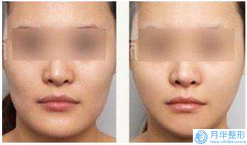深圳顏美整形美容門診部?jī)r(jià)格(價(jià)目)表均價(jià)一覽-唇珠案例