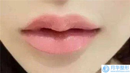 韶關(guān)取下巴假體手術(shù)適應(yīng)的人群有哪些