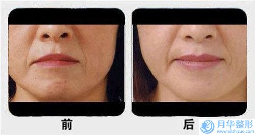 焦作陶子醫(yī)療美容整形診所整形收費明細項目全新一覽-下巴長手術(shù)案例