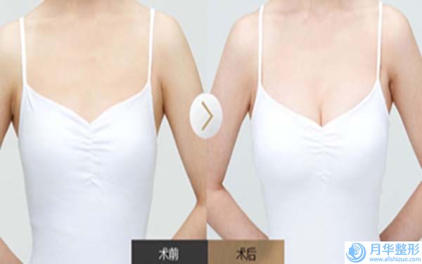 彭夢(mèng)龍整形醫(yī)生-黃岡市彭夢(mèng)龍醫(yī)生額頭用自體脂肪填充優(yōu)勢(shì)突出