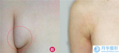 雙鴨山面部做豐額頭的手術過程和適應人群