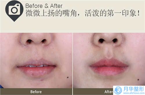 攀枝花明皓口腔醫(yī)院下巴整容手術(shù)效果很好