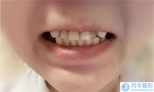 揭陽中藥治療減肥失敗二次修復(fù)效果怎么樣，多少錢