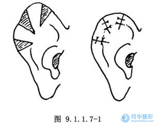 理療豐胸整形手術(shù)適合多大年齡的人