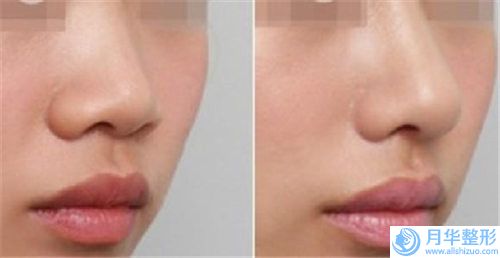 美鼻對(duì)身體有什么傷害嗎,美鼻有負(fù)作用嗎