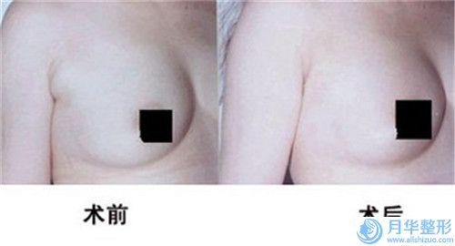 長(zhǎng)春市哪家三甲醫(yī)院整形額頭削骨良好(吉林省人民醫(yī)院整形外科助力變美)