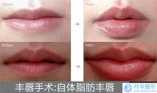 龍巖墊下巴瘦臉術(shù)北京收費(fèi)標(biāo)準(zhǔn)如何