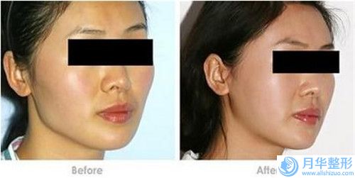 鼻唇裂修復(fù)的適應(yīng)人群有哪些需要注意什么