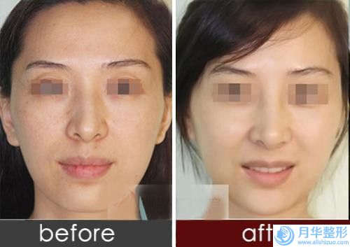 天水墊眉弓骨價(jià)格不同的原因是什么