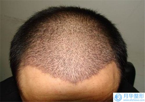 陽(yáng)江瘦臉針打小v臉手術(shù)對(duì)視力是否有影響