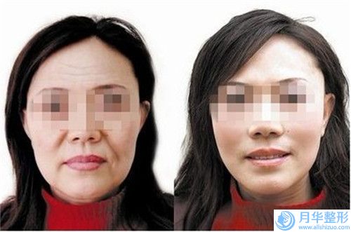 一支玻尿酸豐唇不當(dāng)會(huì)產(chǎn)生哪些副作用