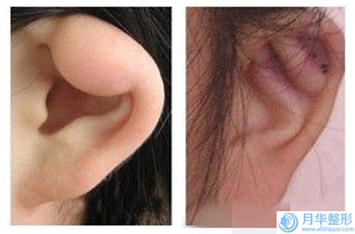馬鞍山整形美容醫(yī)院整形價(jià)目表全新一覽-內(nèi)陷乳頭矯正器案例