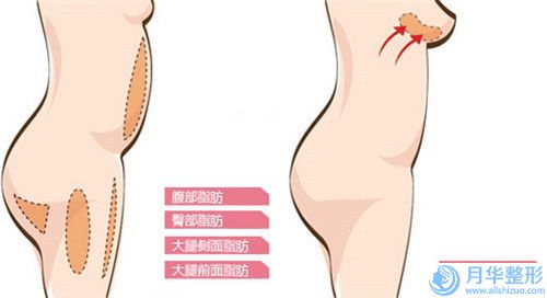 中山額植發(fā)術(shù)的費(fèi)用大致是多少