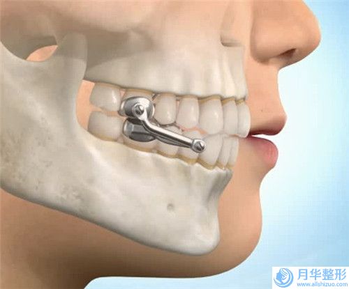 北京亞楠容悅整形醫(yī)院注射器吸脂瘦手臂技術(shù)怎么樣院內(nèi)口碑、實(shí)力指南