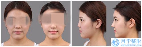 許昌鼻隆鼻假體術(shù)的價(jià)格受什么因素的影響