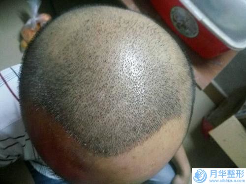 漯河射頻溶脂瘦臉手術(shù)優(yōu)缺點(diǎn)和禁忌人群有哪些