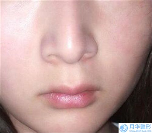 合肥鼻子畸形修復矯正術(shù)的安全性有多高