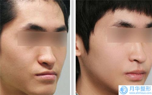 兔唇 唇裂做了有副作用嗎「兔唇 唇裂副作用有嗎」