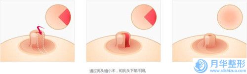 雅安自體移植豐額頭會(huì)影響視力嗎