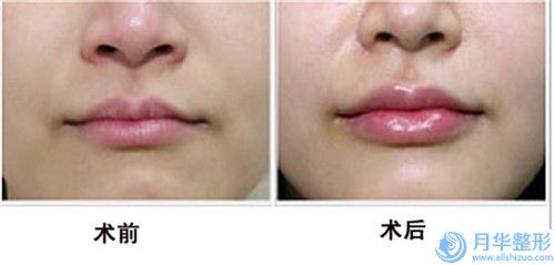 揚州下巴縮矯正術大約得需多少錢