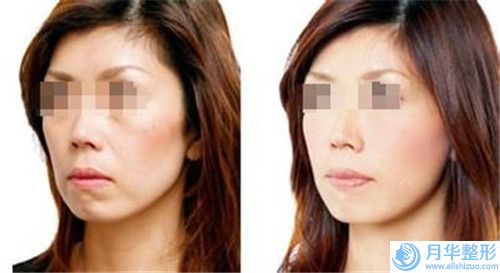 婁底法眉術(shù)的費用是多少呢,婁底法眉的費用具體是多少