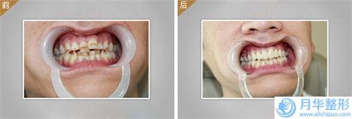 延邊水動(dòng)力吸脂瘦腿具體費(fèi)用多少呢
