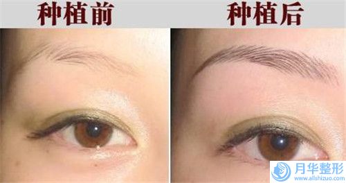 溶脂跟瘦臉針會有致癌風險嗎「溶脂跟瘦臉針術(shù)有風險么」