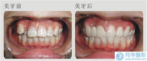 整形醫(yī)院手臂環(huán)吸抽脂推薦：手臂環(huán)吸抽脂醫(yī)院前30名正規(guī)認(rèn)證