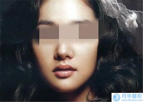 梅州市玻尿酸去下巴收費(fèi)明細(xì)項(xiàng)目大揭底(玻尿酸去下巴是怎么收取費(fèi)用)