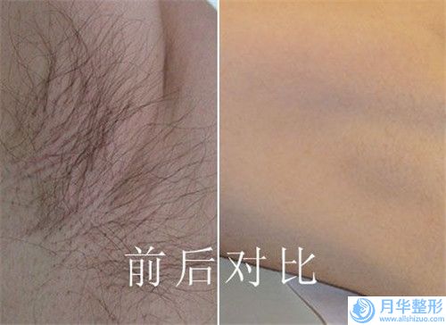 緊致面部肌膚整形是否會有后遺癥