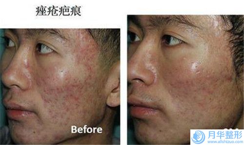 撫州做豐太陽穴手術(shù)后多久才看到效果