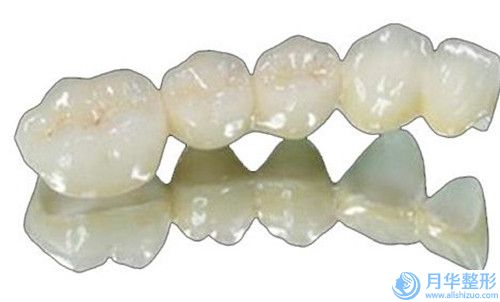 信陽樹脂粘全瓷冠有危險(xiǎn)不