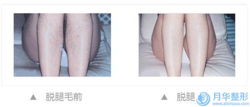 滄州楓華整形醫(yī)院整形價格價位表在線更新-面部懸吊術案例