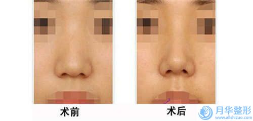承德萊美醫(yī)療美容醫(yī)院整形價格(費用)清單2024全新展示-面吸雙下巴案例