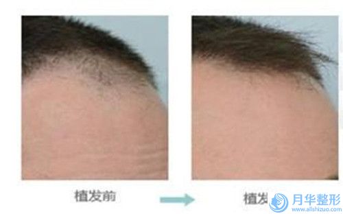 常州市武進(jìn)人民醫(yī)院南院整形美容科整形價格收費表2024發(fā)布-臉上舊疤痕去除案例