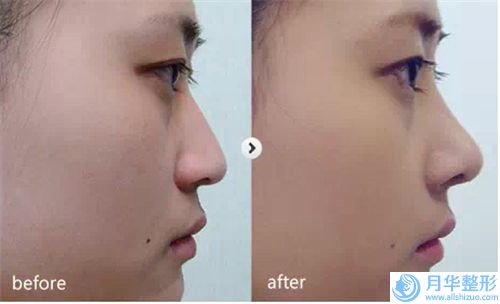 石家莊瑞亞皮膚美容管理中心價(jià)格(價(jià)目)2024全新揭秘一覽-鼻咽部腺體樣肥大治療案例