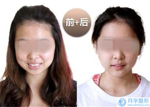 秦皇島美姿嬌醫(yī)療美容診所收費標準目錄公開-假體下巴手術案例
