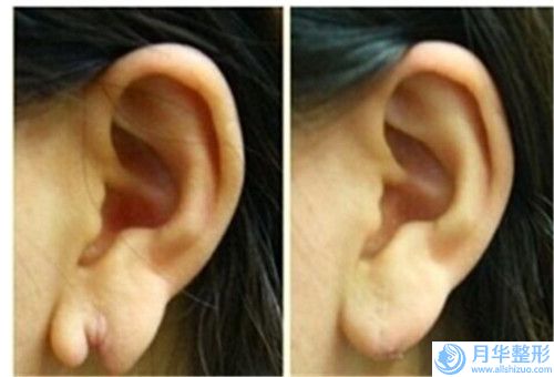 達(dá)州乳房松弛下垂矯正手術(shù)的費(fèi)用會(huì)受哪些因素影響