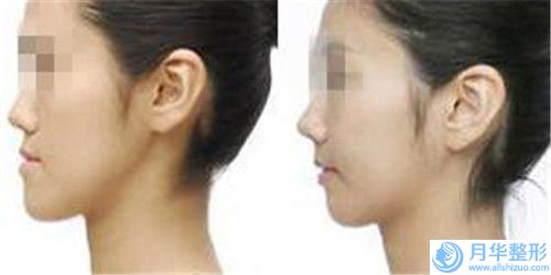 哪家手臂抽脂醫(yī)院推薦：手臂抽脂醫(yī)院前30重磅推出