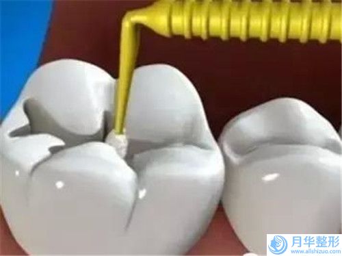 自體脂肪治療的潛在副作用