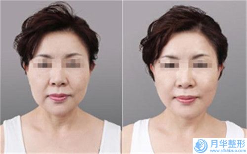 無創(chuàng)洗眉毛的效果維持時間及護理事項