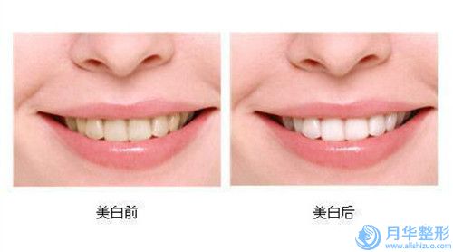長沙三和整形美容醫(yī)院價格價位表免費觀看-腹部抽脂案例