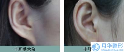 整形取出假體乳房修復(fù)醫(yī)院推薦：取出假體乳房修復(fù)醫(yī)院前30知名盤點(diǎn)