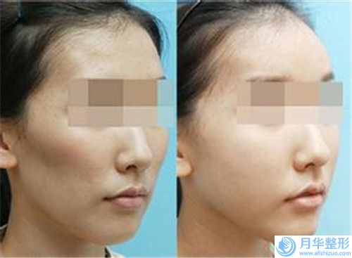 大連甘井子騰金芳醫(yī)療美容診所整形價(jià)格(價(jià)目)詳細(xì)版-紋眉失敗修復(fù)案例