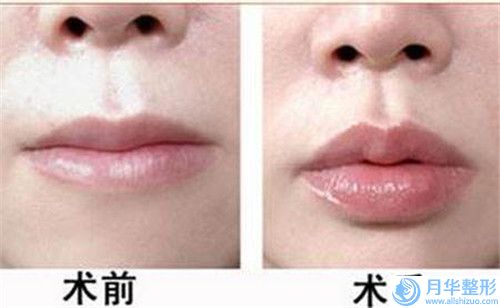鄭州市下巴肉多打溶脂針整形醫(yī)院上榜清單前三在此(鄭州鄭東美康中宇醫(yī)療美容告訴你哪個好且實惠)