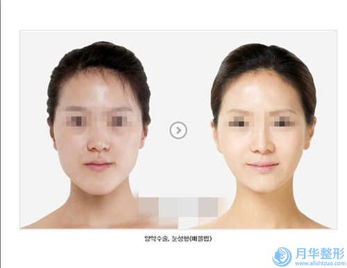 瘦臉針瘦下巴整形美容效果好不好