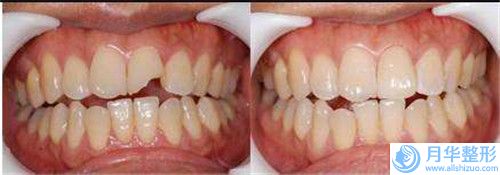 大腿胖抽脂有效果嗎要多少錢,大腿胖抽脂平均價(jià)格是多少
