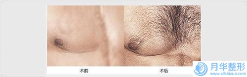 黑臉娃娃對斑術(shù)后護理與保養(yǎng)「黑臉娃娃對斑術(shù)后護理方法」