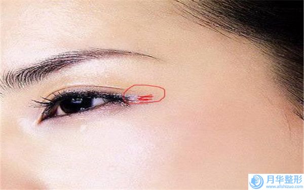 藥物治療雀斑三大治療效果是什么